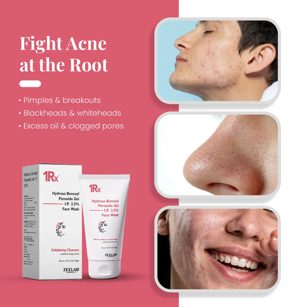 1RX Hydrous Benzoyl Peroxide 2.5% Face Wash, 100gm